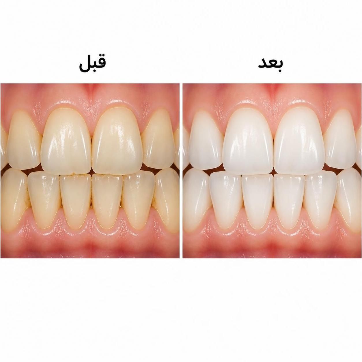 پکیج سرم سفید کننده دندان لانبنا مسواک برقی شیائومی مدل X3 قابل شارژ ضدآب - تصویر 2